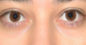 Natural Treatment for Oily skin